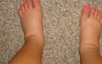 Набряки при вагітності як вилікувати?