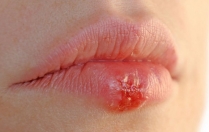 Як герпес впливає на вагітність