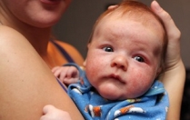 Симптоми і лікування атопічного дерматиту у дітей