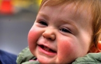 Як вилікувати діатез у дитини на щоках?