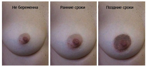 Як змінюється груди під час вагітності?