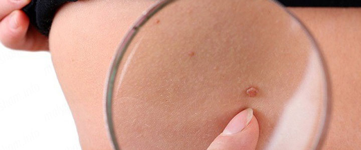 Як лікувати папіломи при вагітності?