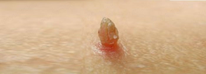 Як лікувати папіломи при вагітності?