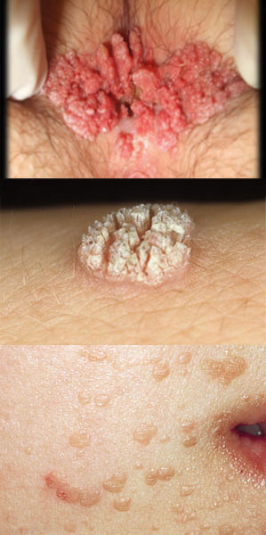 Як лікувати папіломи при вагітності?