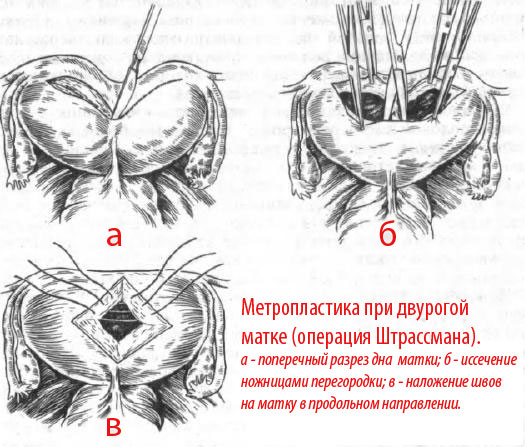 Чи можна народити при дворогій матці? Відповіді лікарів