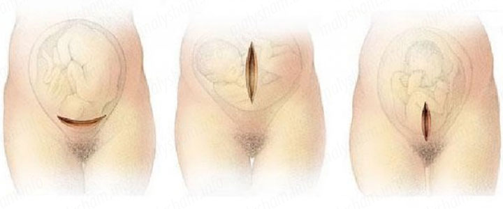 Показання до кесаревого розтину: вирок без оскарження або всього лише рекомендація?