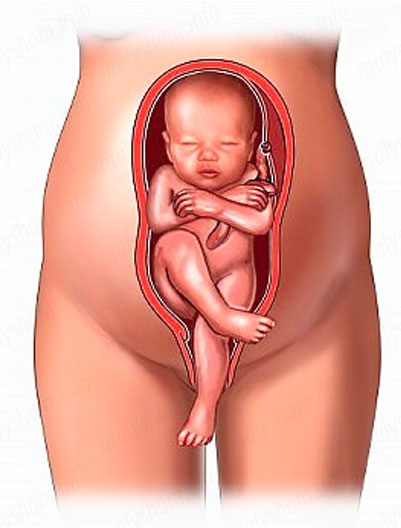 Показання до кесаревого розтину: вирок без оскарження або всього лише рекомендація?