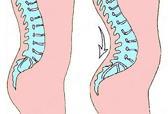 Біль в попереку пологів: причини, вправи і рекомендації