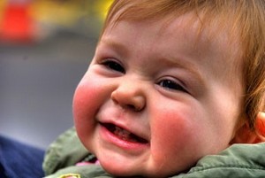 діатез у дитини