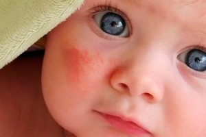 Алергія у новонародженого на обличчі: що робити батькам?