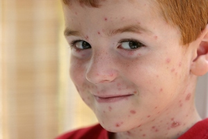 вітрянка у дітей