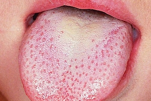 У дитини білий наліт на язиці: причини і лікування