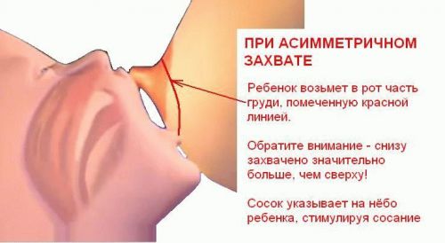 Чому болять груди при грудному вигодовуванні Чому болять груди при грудному вигодовуванні