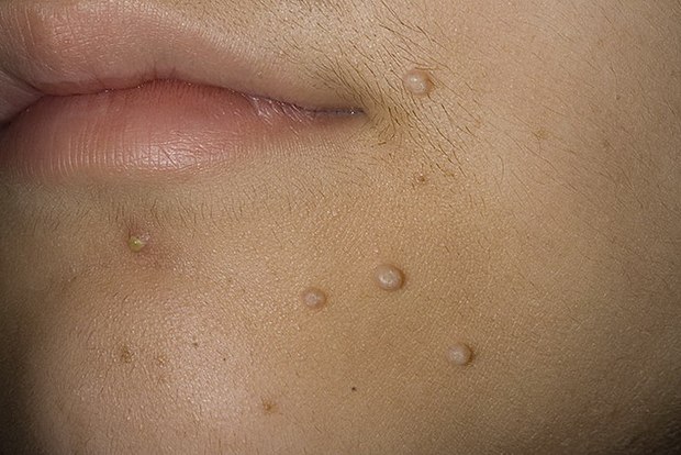 Контагіозний молюск на шкірі у дітей