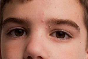 Контагіозний молюск на шкірі у дітей: діагностика та лікування