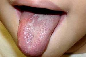 Білий наліт на язику новонародженого - що робити