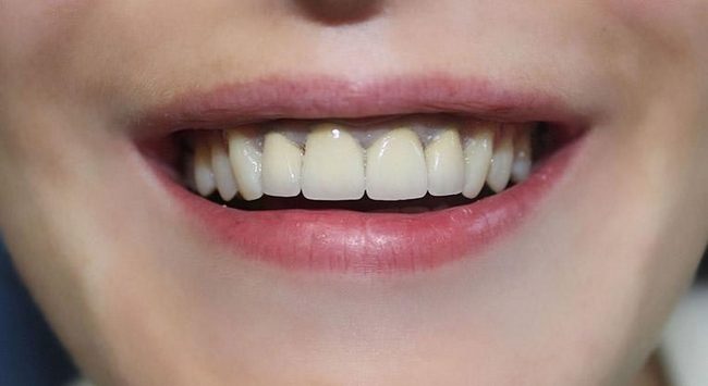 Что собой представляют металлокерамические коронки