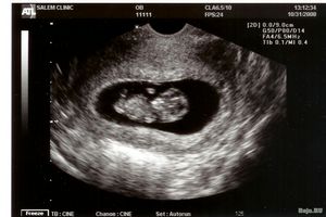 10 (десятий) тиждень вагітності