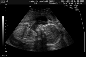 20 (двадцятий) тиждень вагітності