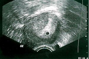 4 (четвертий) тиждень вагітності