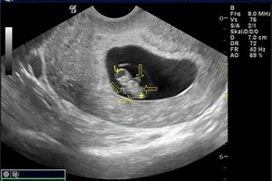 7 (сьомий) тиждень вагітності
