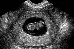 6 (шостий) тиждень вагітності