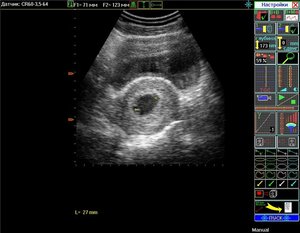 3 (третій) тиждень вагітності