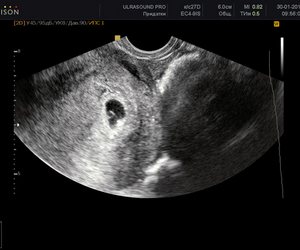 5 (п'ятий) тиждень вагітності